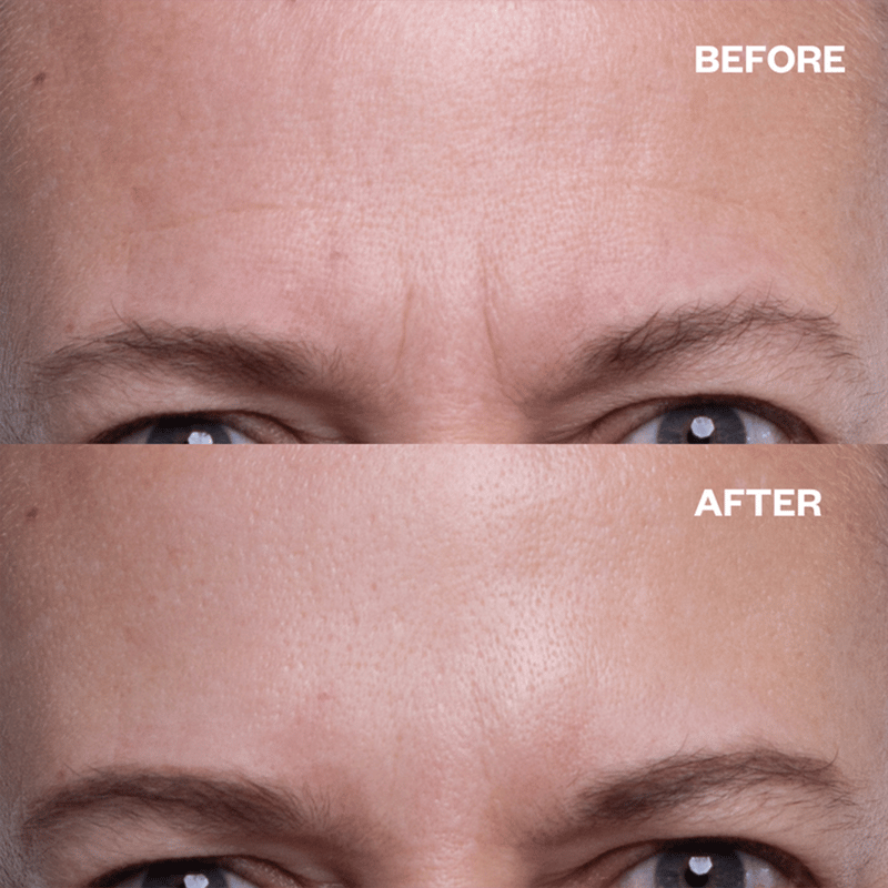 SmoothSilker™ – Silicone anti-Wrinkle Patch