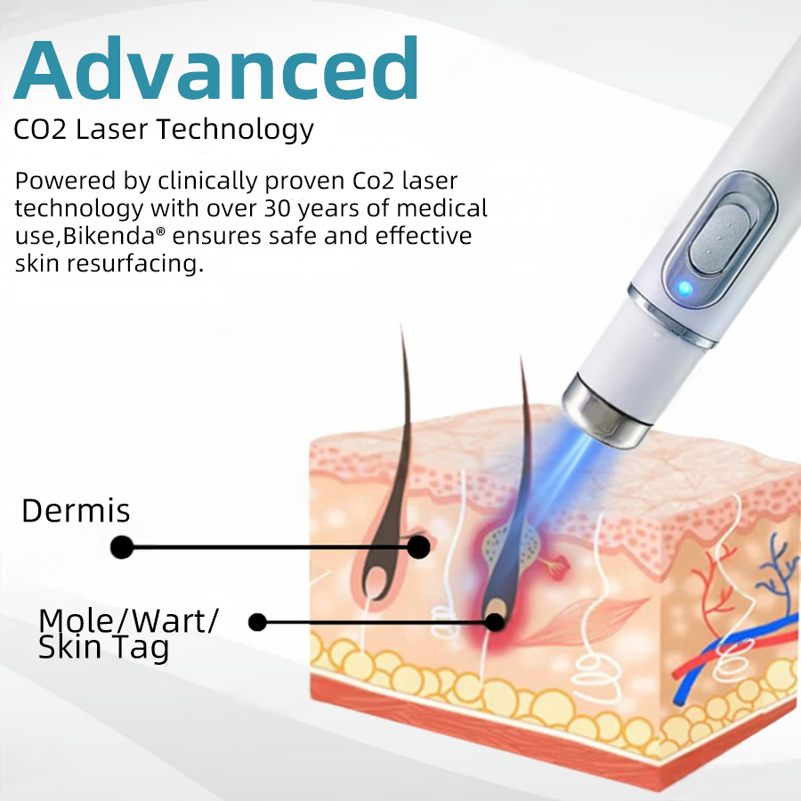 WartNoMore™ – Laser Pen