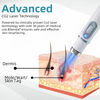 WartNoMore™ – Laser Pen