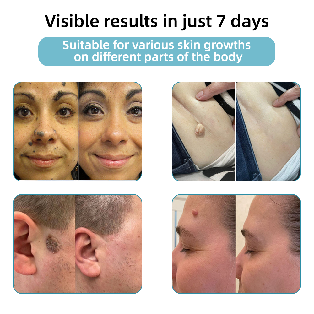 WartLaserPen™ – Laser Mole and Wart Remover