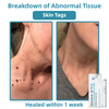 WartLaserPen™ – Laser Mole and Wart Remover