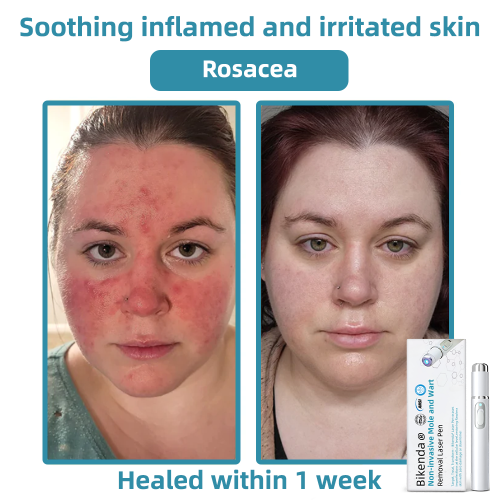 WartLaserPen™ – Laser Mole and Wart Remover