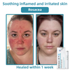WartLaserPen™ – Laser Mole and Wart Remover