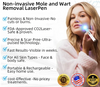 WartNoMore™ – Laser Pen