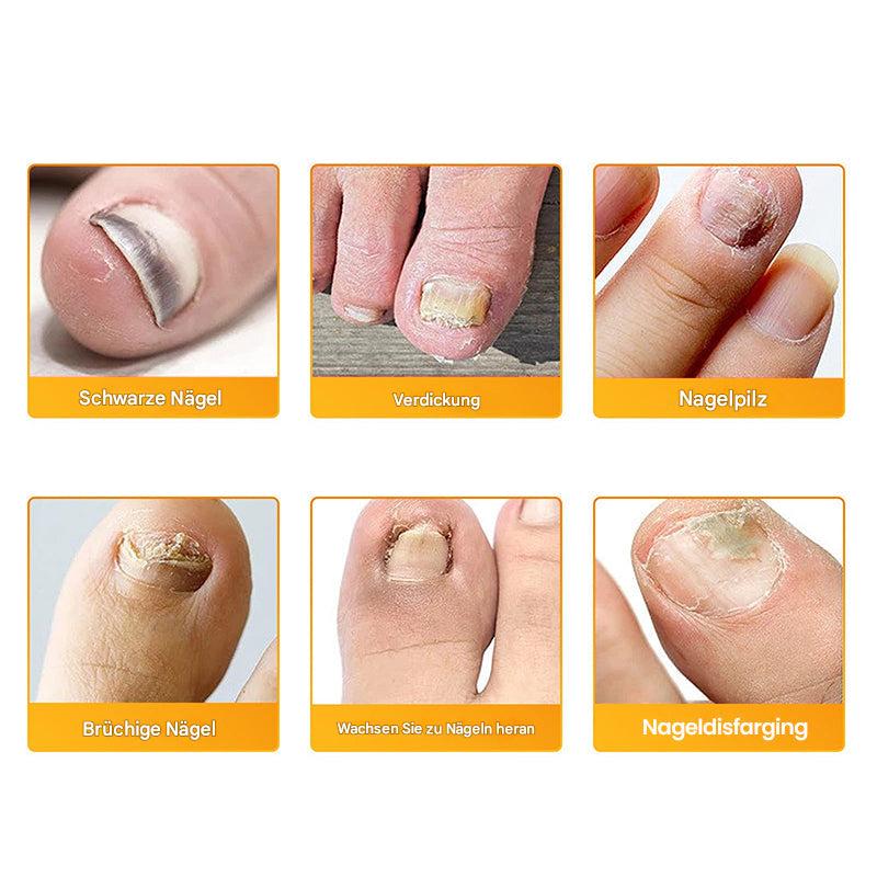 1+1 Free | Nailoxx™ – Discreet Ant-fungal Nail Patches