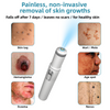 WartNoMore™ – Laser Pen