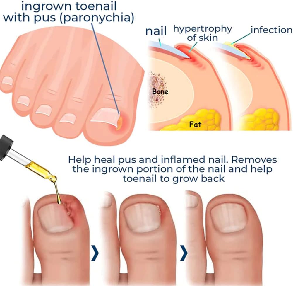 1+1 Free | DropToes™ – Nail Repair Serum