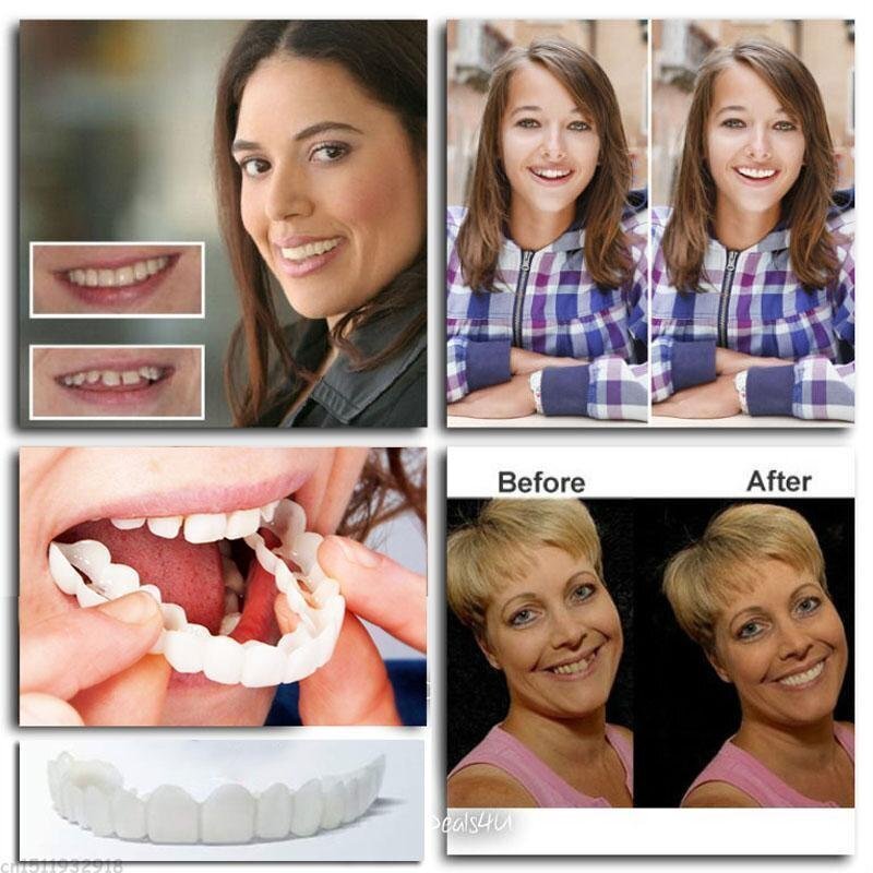 DentureSnap™ – Instant Snap-On Veneers