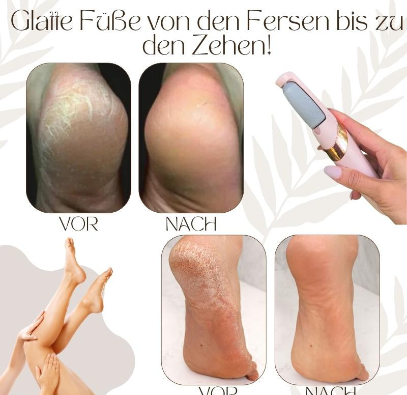 Callusos™ – Electric Callus Remover