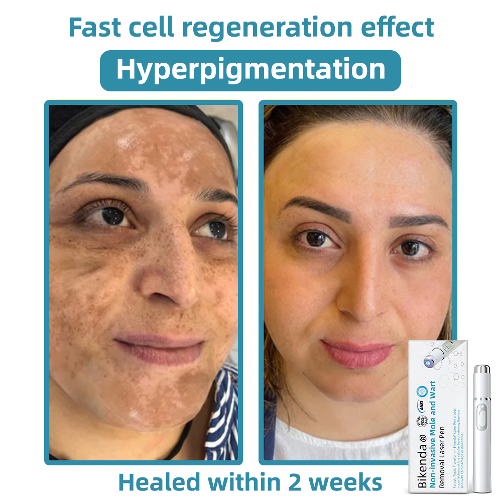 WartLaserPen™ – Laser Mole and Wart Remover