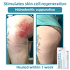 WartLaserPen™ – Laser Mole and Wart Remover