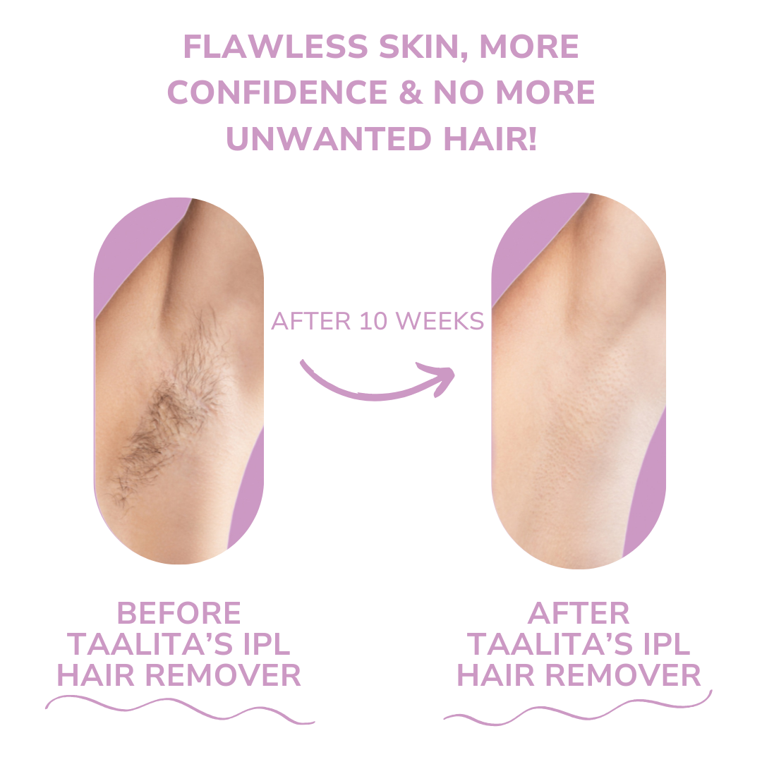 GlowSoftSkin™ – Pain-free IPL Laser Hair Remover