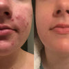1+1 Free | GlowScar™ – Silicone Scar Removal Sheets