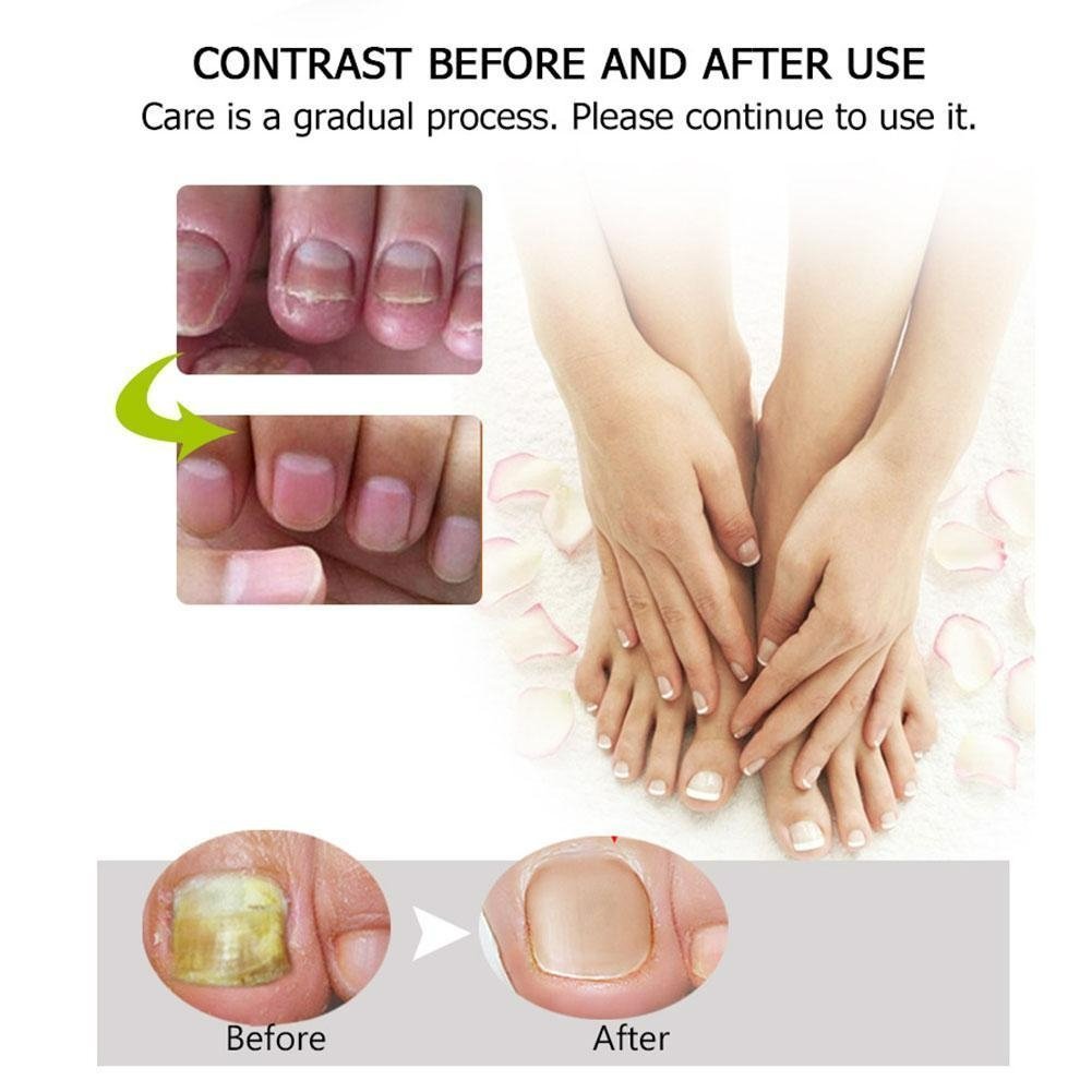 1+1 Free | Naily™ – Fast and Effective Results