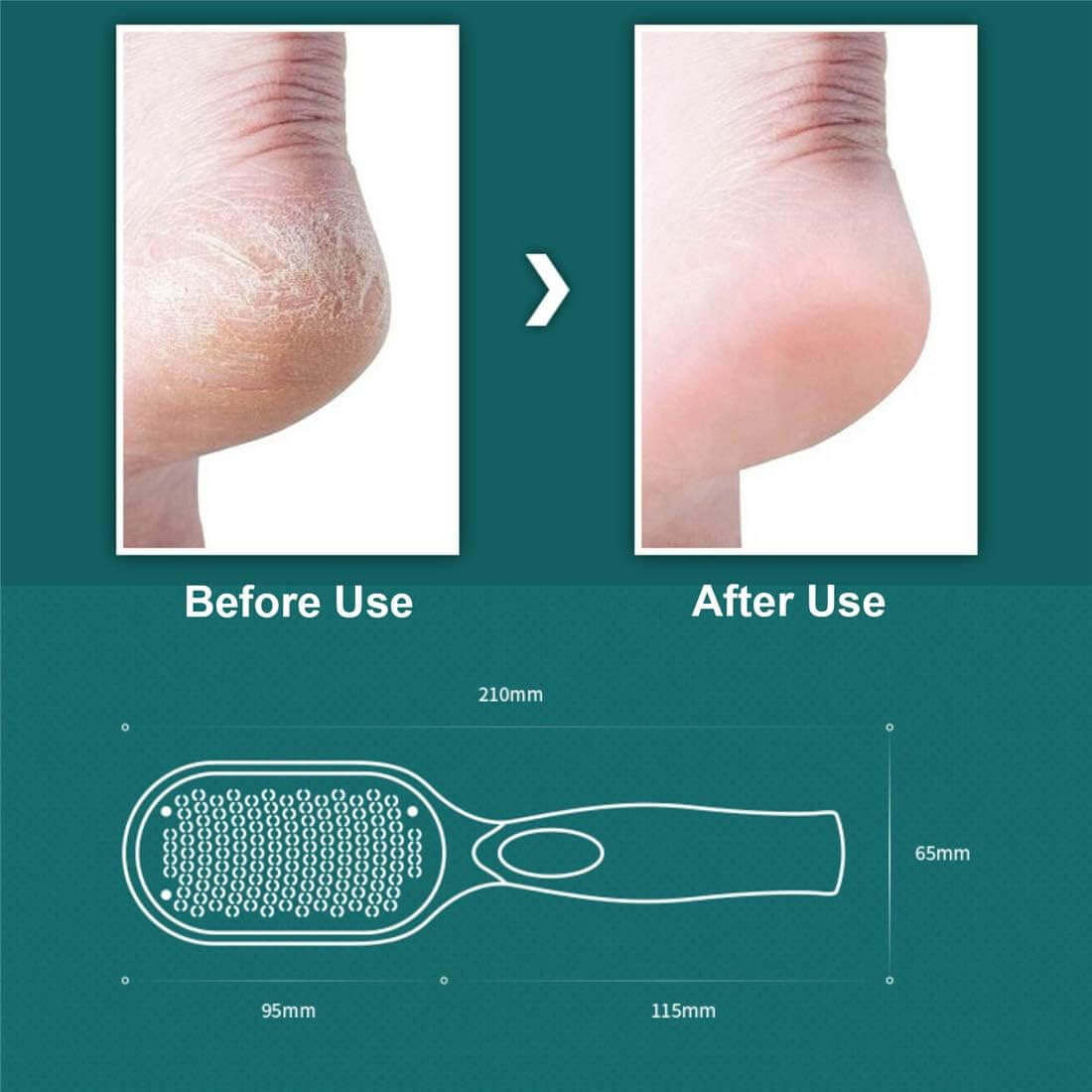 PeelPro™ – Callus Remover for the Feet