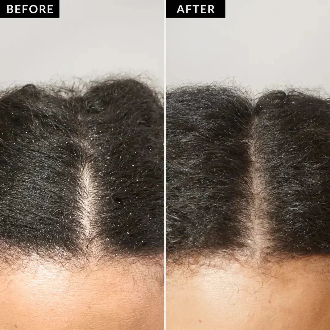 1+1 Free | MassageComber™ – Portable Scalp Massage Brush